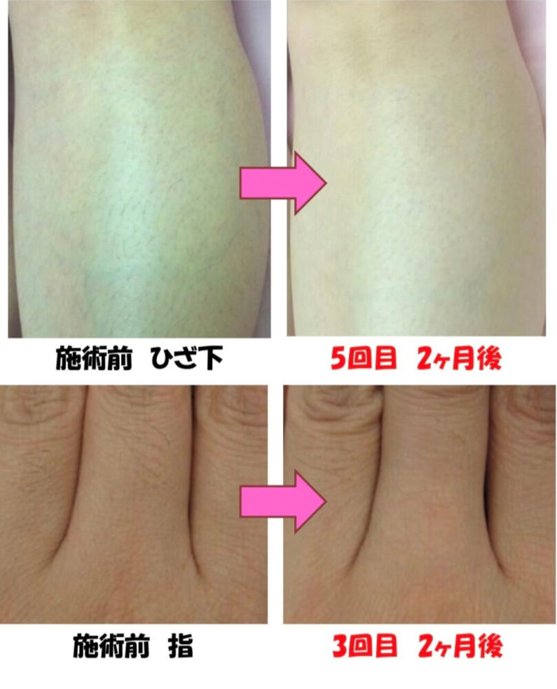 Before After4