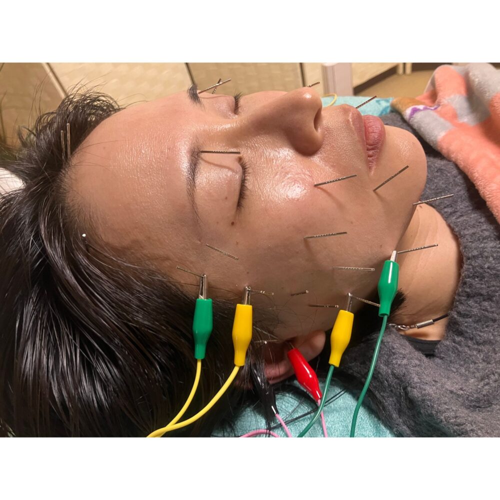 名古屋市守山区にある鍼灸HEROさんの鍼灸治療(TOP)