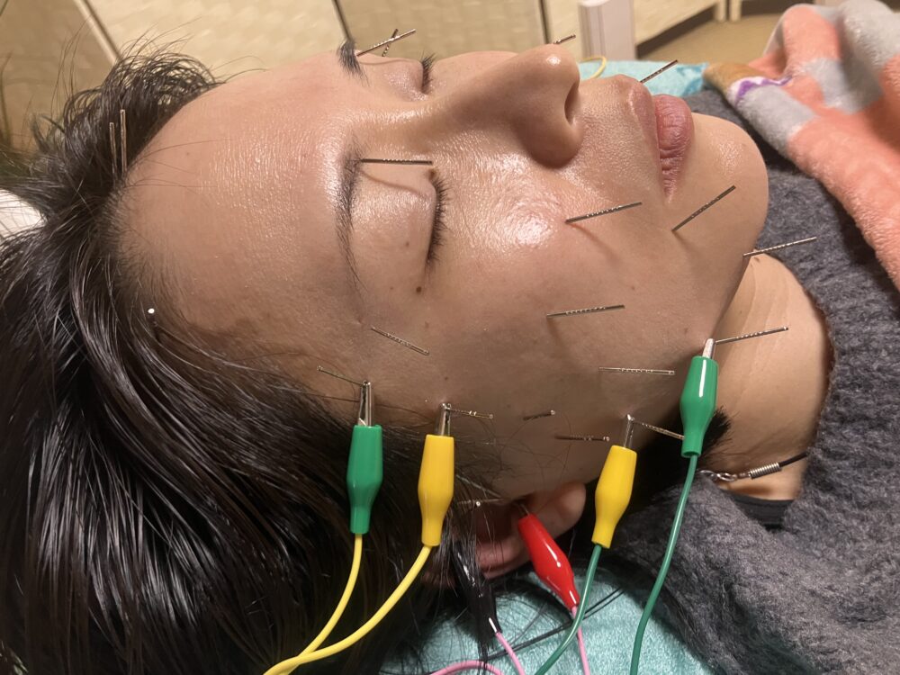 名古屋市守山区 プライベートサロン 鍼灸HEROさんの鍼灸施術