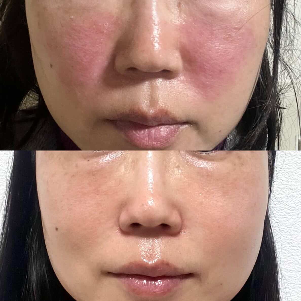 敏感肌・赤みが気になる肌のケアイメージ｜福麗Pharm beauty lab FUKUOKA